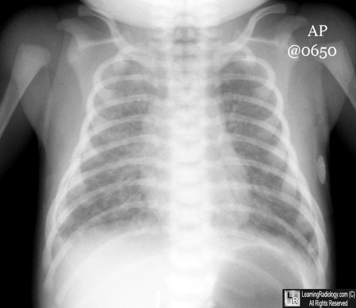 Meconium Aspiration Syndrome